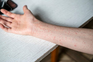 Measles Cases Surge to 186 in Maldives; HPA Urges Vaccination