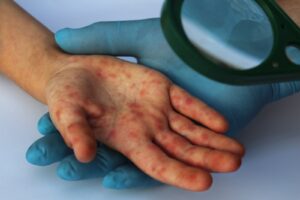 Measles cases rise to 166 in Maldives
